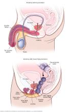 Anatomy before and after bowel flap procedure