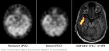 A set of brain images shows a nonseizure SPECT, a seizure SPECT and a subtraction SPECT coregistered to MRI.