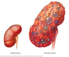 A typical kidney compared with a polycystic kidney