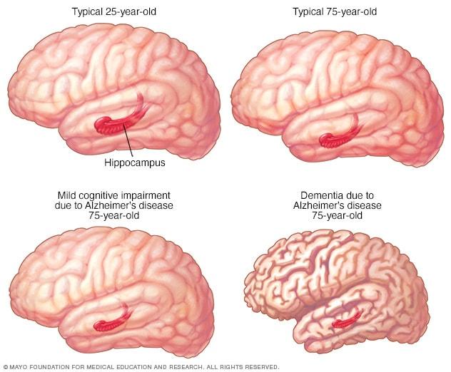 Changes in brain structure in MCI and Alzheimer's disease