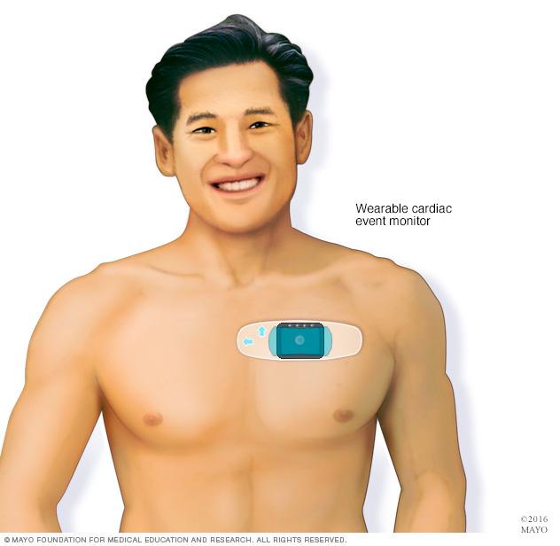 Cardiac event monitor