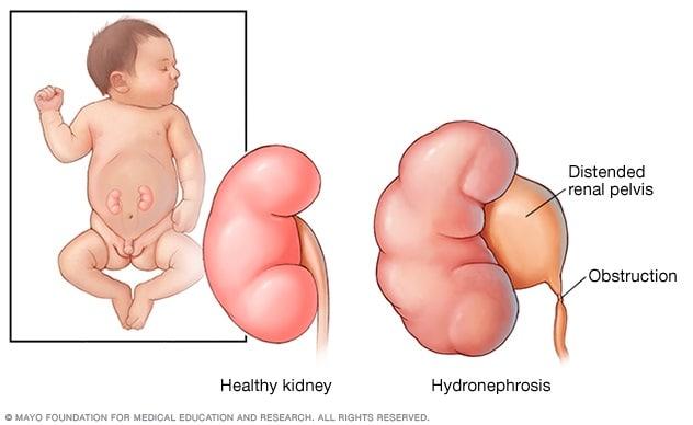 Typical kidney and a kidney with hydronephrosis in an infant