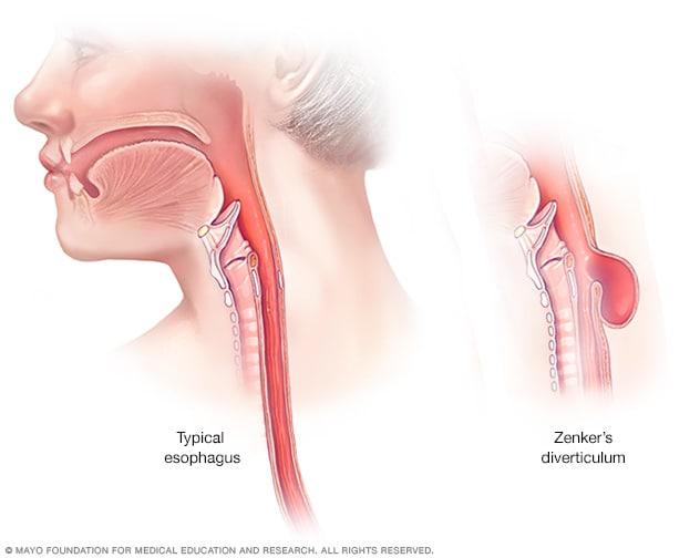 Zenker's diverticulum